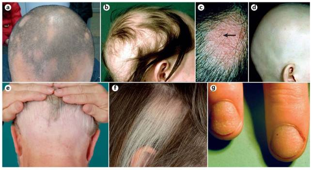 O Que Alopecia Clinica Silvia Rodrigues
